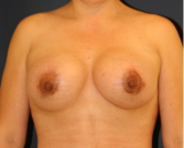 Feel Beautiful - Breast Augmentation-Lift 51 - After Photo